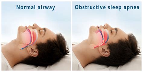 sleep apnea po polsku|sleep apnea .
